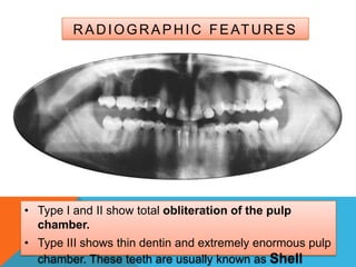 R A D I O G R A P H I C F E AT U R E S




• Type I and II show total obliteration of the pulp
  chamber.
• Type III shows thin dentin and extremely enormous pulp
  chamber. These teeth are usually known as Shell
 