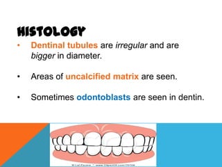 Histology
•   Dentinal tubules are irregular and are
    bigger in diameter.

•   Areas of uncalcified matrix are seen.

•   Sometimes odontoblasts are seen in dentin.
 