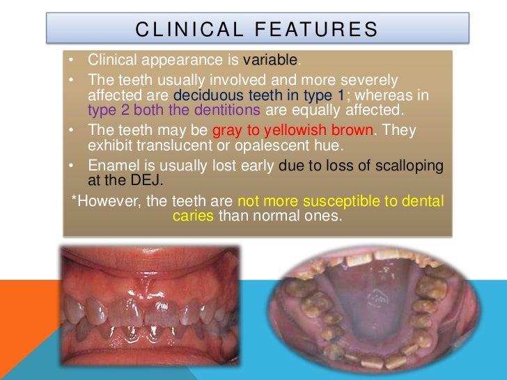 Dentinogenesis imperfecta