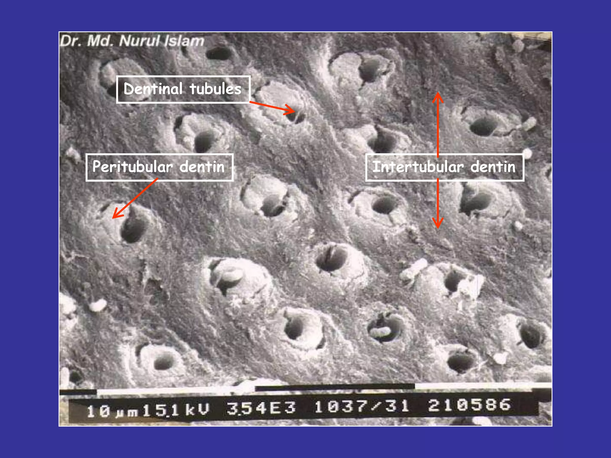 Dentinal tubules




Peritubular dentin     Intertubular dentin
 