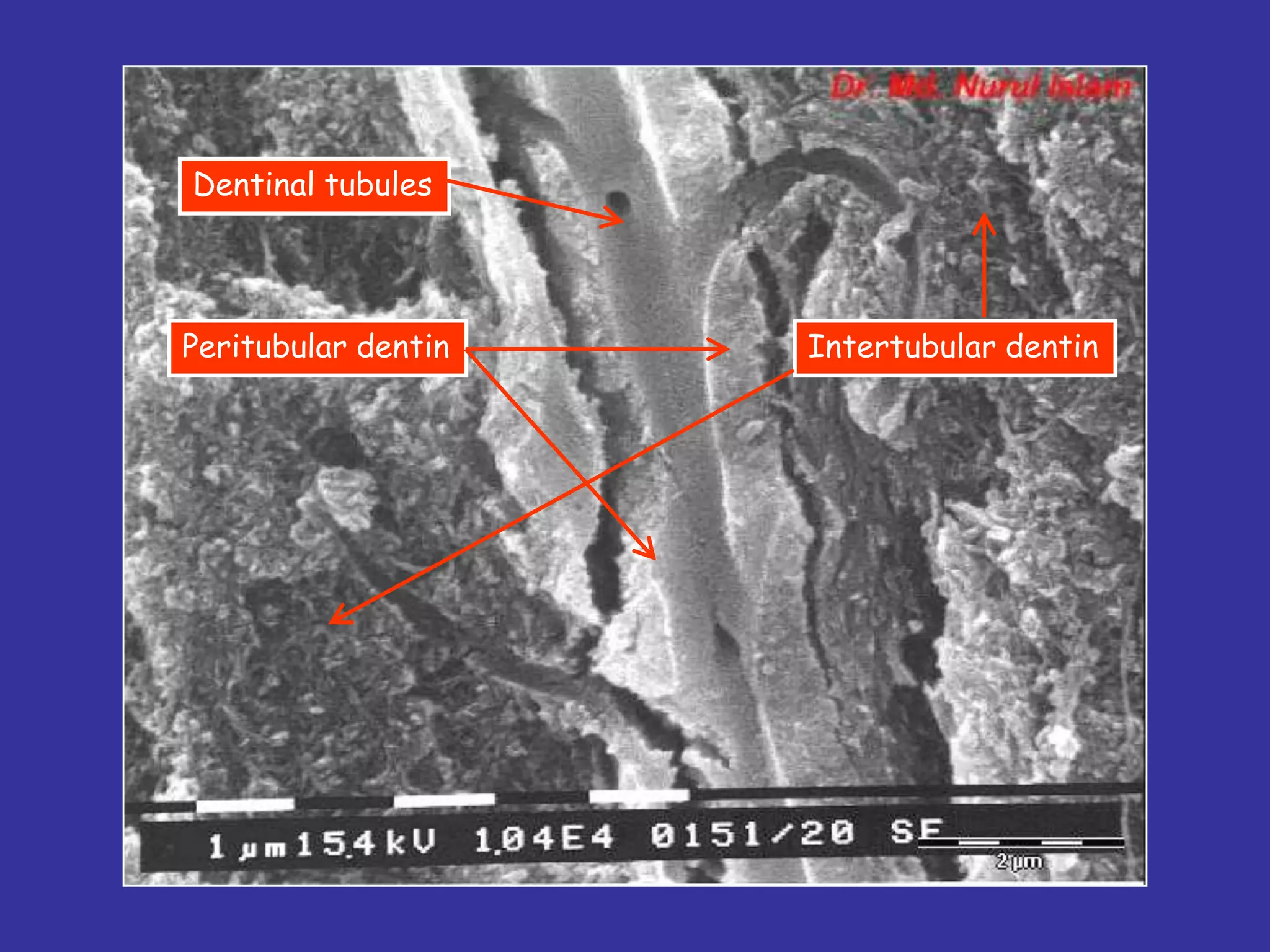 Dentinal tubules




Peritubular dentin   Intertubular dentin
 