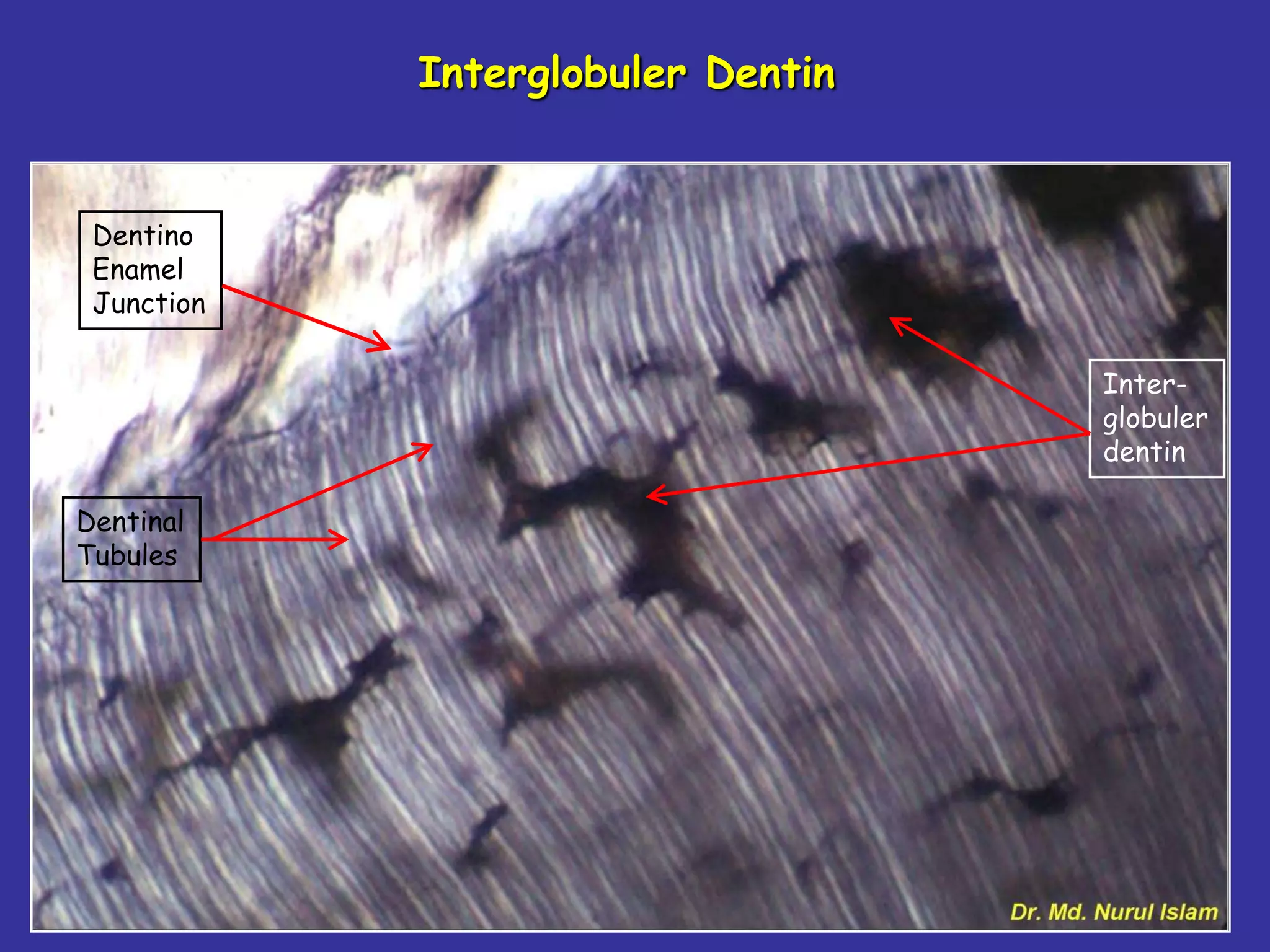 Interglobuler Dentin


 Dentino
 Enamel
 Junction

                                   Inter-
                                   globuler
                                   dentin

Dentinal
Tubules
 