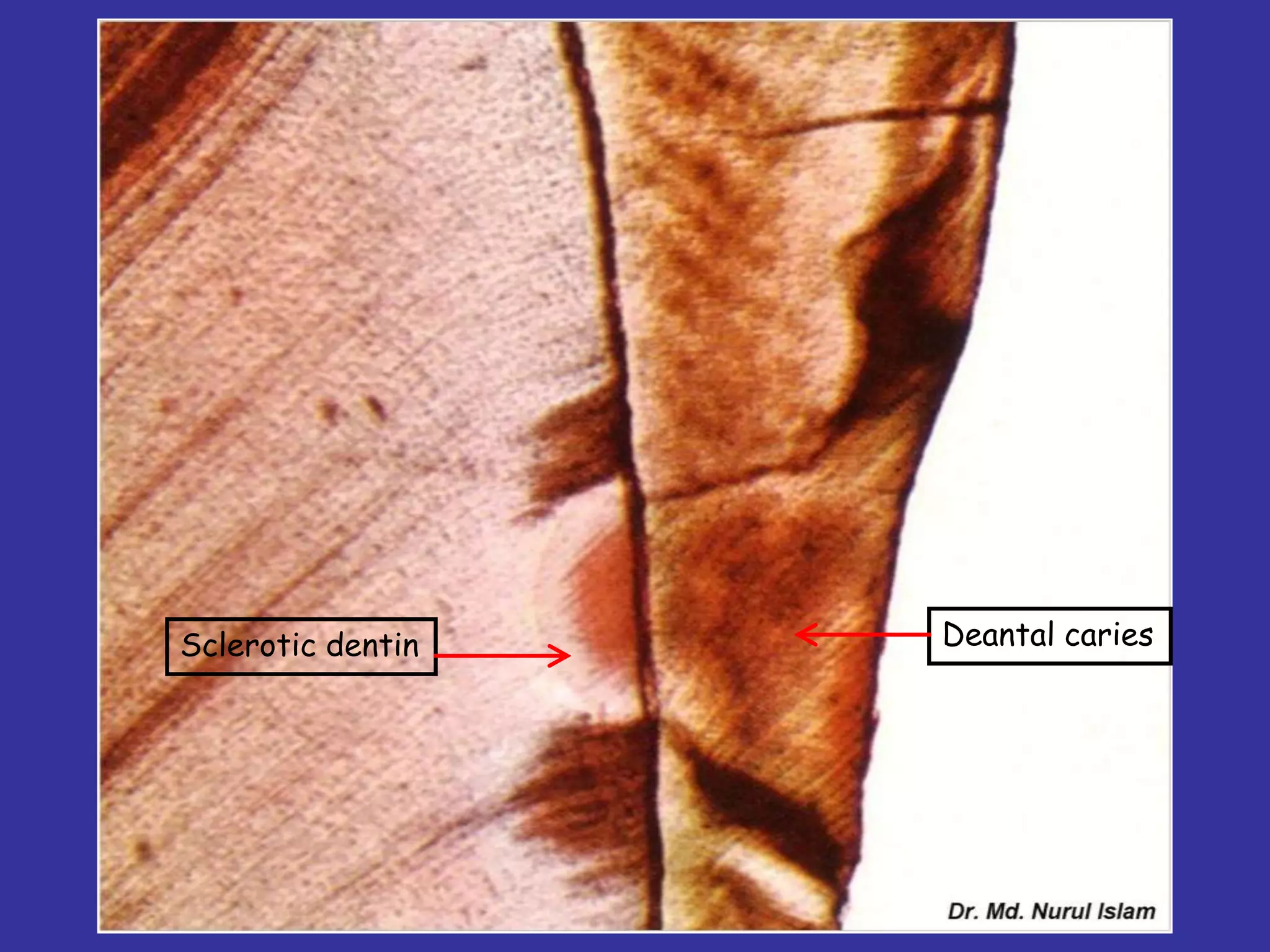 Sclerotic dentin   Deantal caries
 