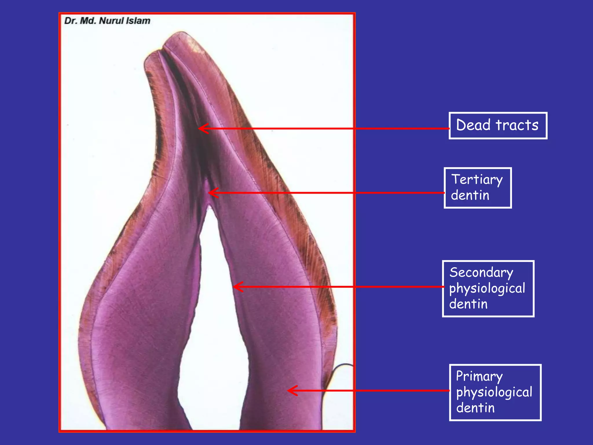 Dead tracts


Tertiary
dentin




Secondary
physiological
dentin




 Primary
 physiological
 dentin
 