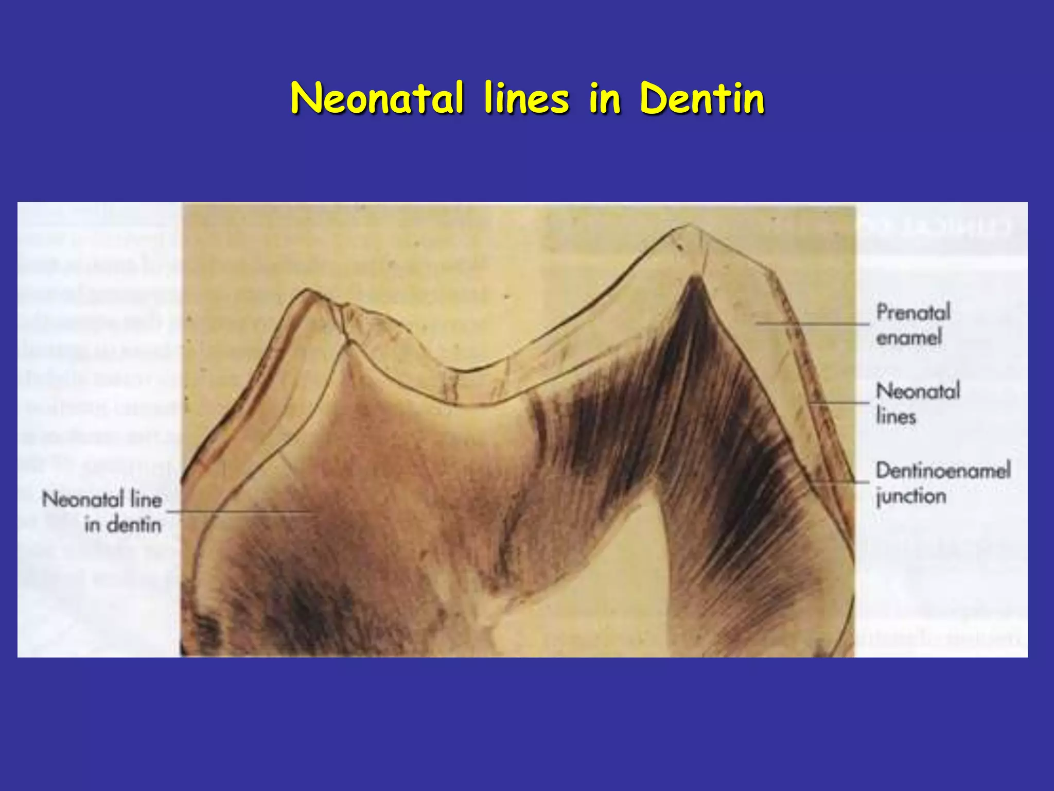Neonatal lines in Dentin
 