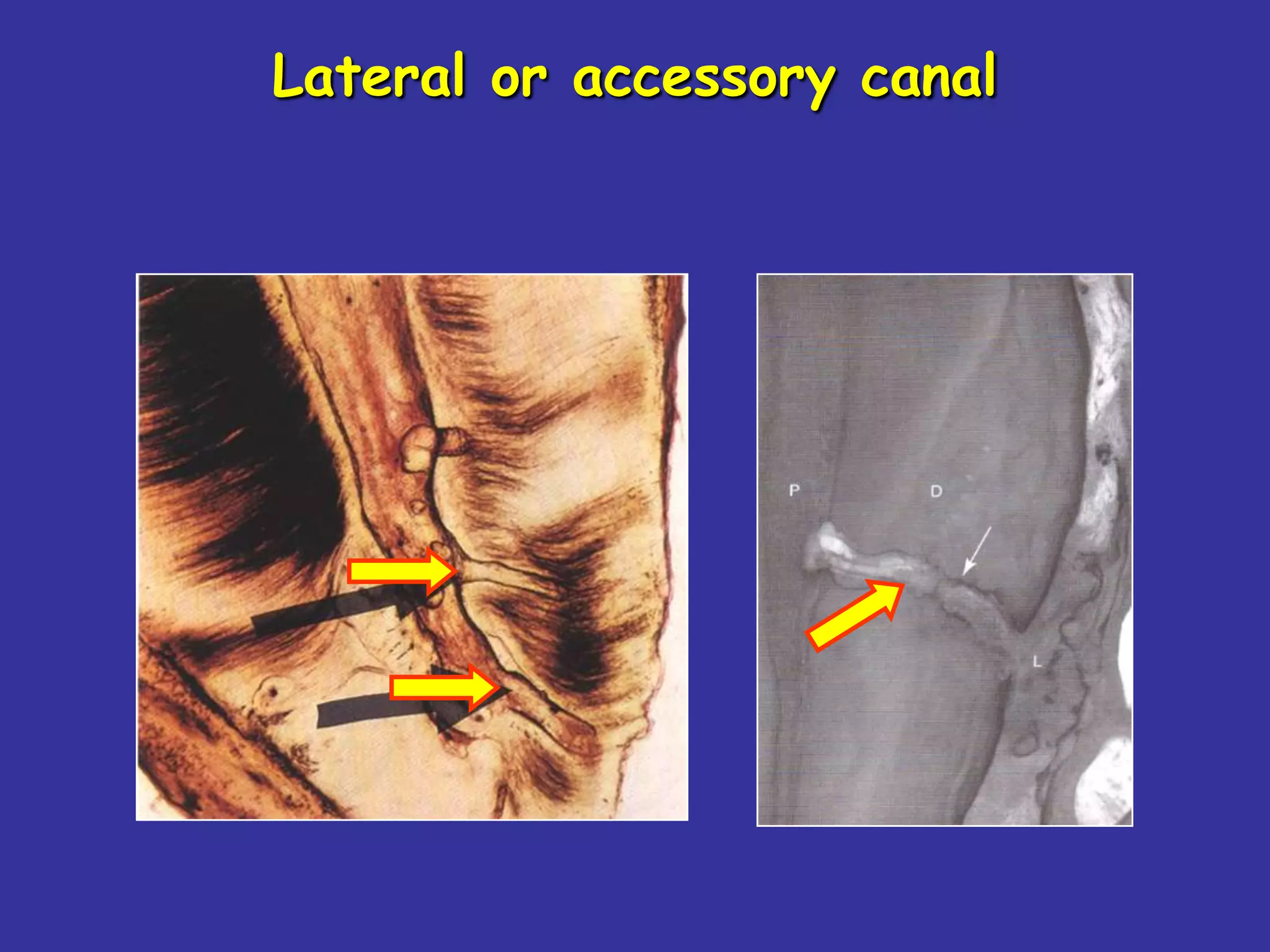 Lateral or accessory canal
 