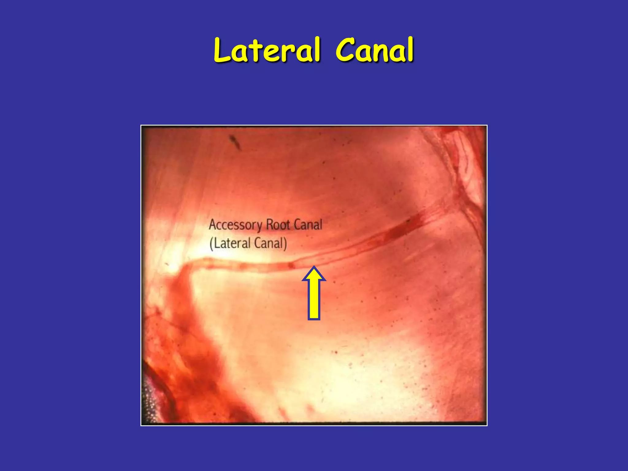 Lateral Canal
 