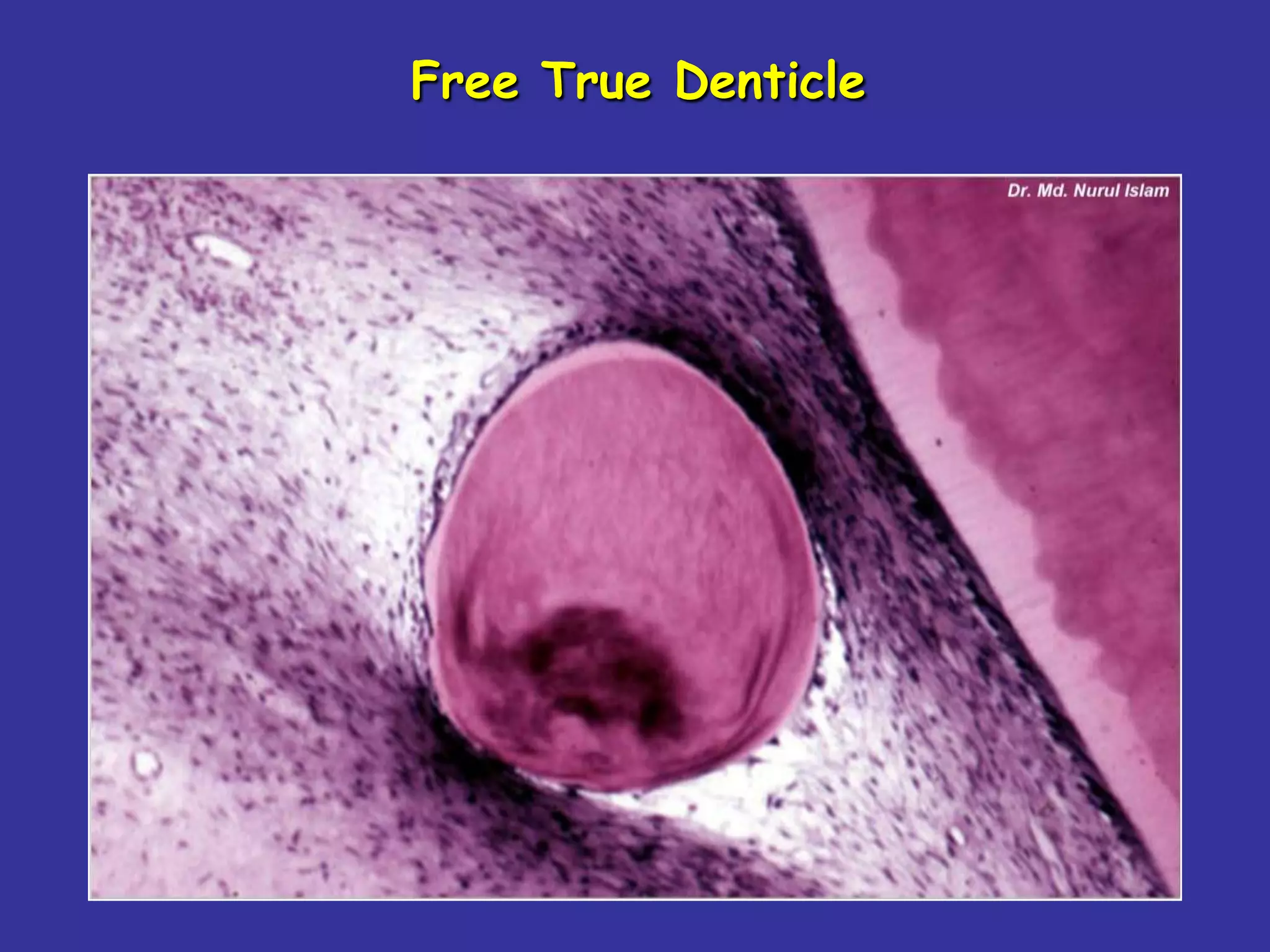 Free True Denticle
 