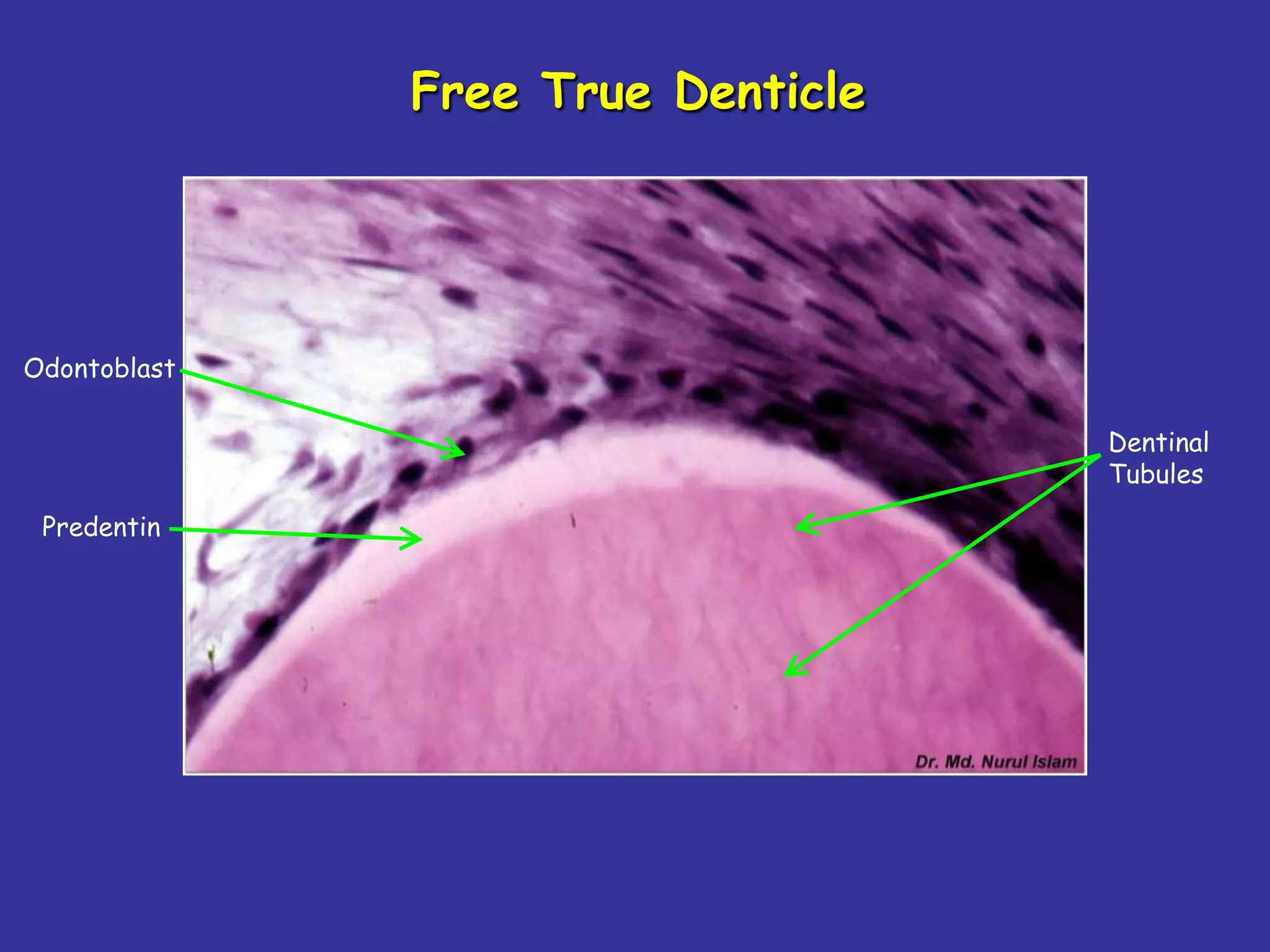 Free True Denticle




Odontoblast

                                   Dentinal
                                   Tubules

 Predentin
 