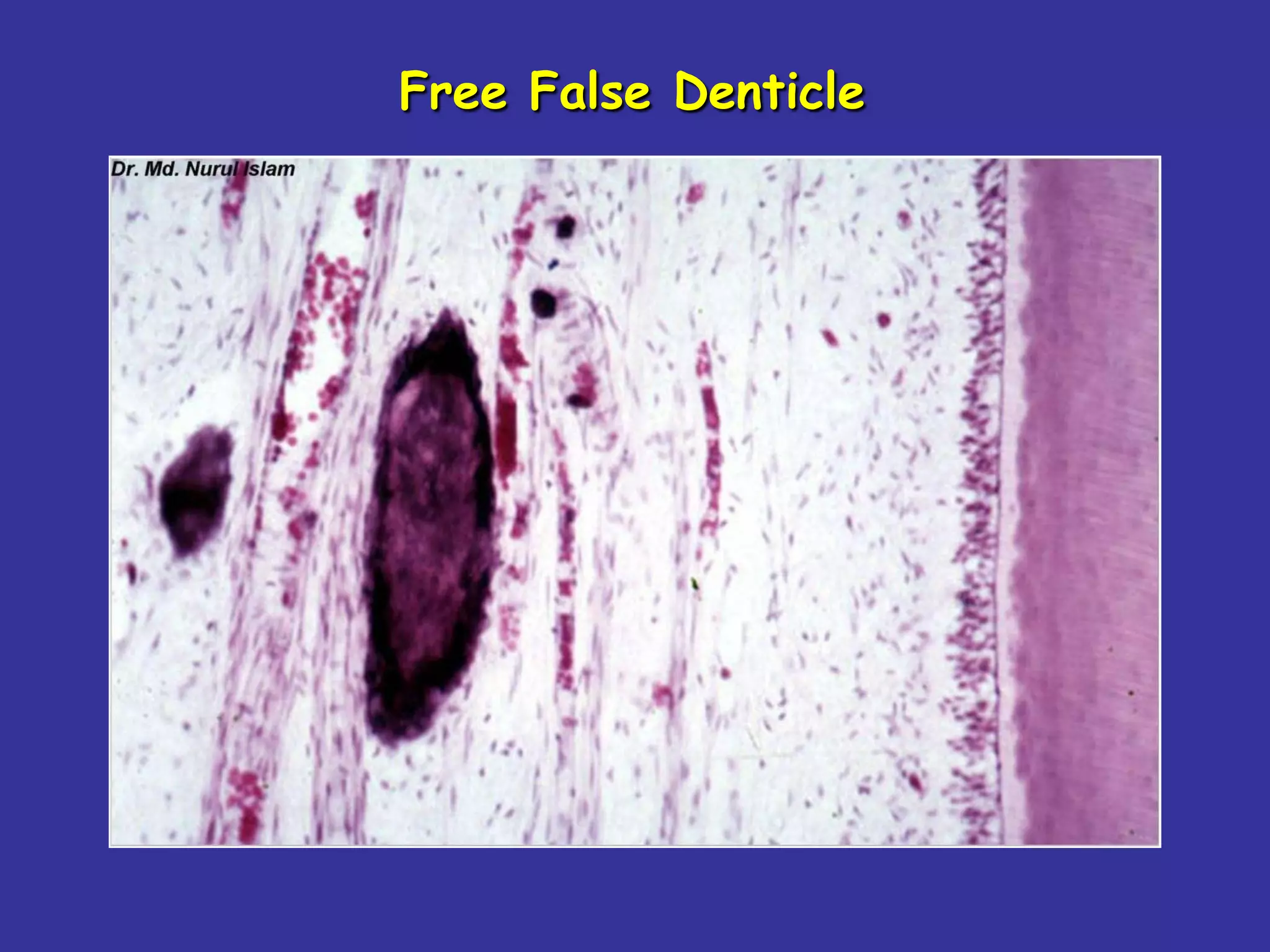Free False Denticle
 