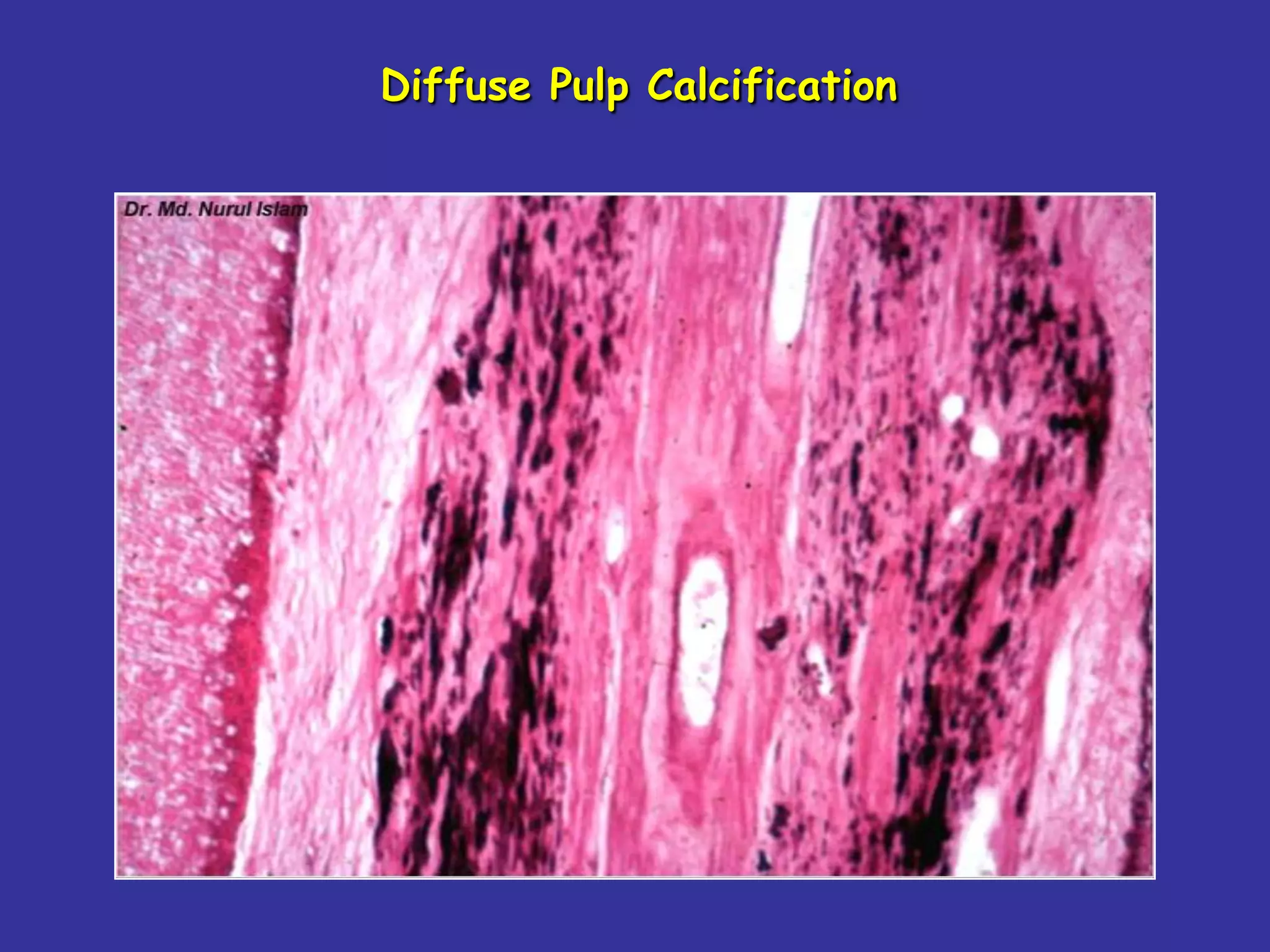 Diffuse Pulp Calcification
 