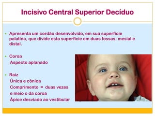 Incisivo Central Superior Decíduo
 Apresenta um cordão desenvolvido, em sua superfície
palatina, que divide esta superfície em duas fossas: mesial e
distal.
 Coroa
Aspecto aplanado
 Raiz
Única e cônica
Comprimento = duas vezes
e meio o da coroa
Ápice desviado ao vestibular br.guiainfantil.com
 