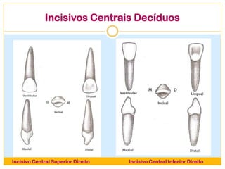 Incisivos Centrais Decíduos
Incisivo Central Superior Direito Incisivo Central Inferior Direito
 