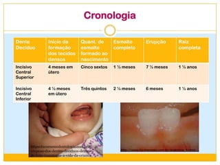 Cronologia
Dente
Decíduo
Início da
formação
dos tecidos
densos
Quant. de
esmalte
formado ao
nascimento
Esmalte
completo
Erupção Raiz
completa
Incisivo
Central
Superior
4 meses em
útero
Cinco sextos 1 ½ meses 7 ½ meses 1 ½ anos
Incisivo
Central
Inferior
4 ½ meses
em útero
Três quintos 2 ½ meses 6 meses 1 ½ anos
httpsolucoesemodontologia.com.bra-
erupcao-dos-dentes-deciduos-dentes-
de-leite-transtorna-a-vida-da-crianca
 