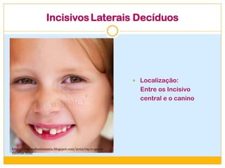 IncisivosLaterais Decíduos
 Localização:
Entre os Incisivo
central e o canino
http://clinicaodontomania.blogspot.com/2010/09/o-que-e-
fluorose.html
 