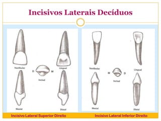 Incisivos Laterais Decíduos
Incisivo Lateral Superior Direito Incisivo Lateral Inferior Direito
 