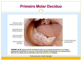 Primeiro Molar Decíduo
 
