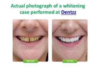 Actual photograph of a whitening 
case performed at Dentzz 
 