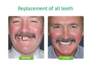 Replacement of all teeth 
 