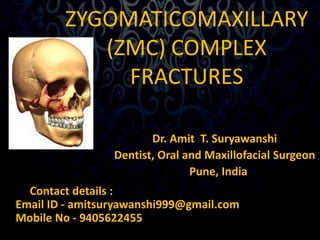 ZYGOMATICOMAXILLARY 
(ZMC) COMPLEX 
FRACTURES 
Dr. Amit T. Suryawanshi 
Dentist, Oral and Maxillofacial Surgeon 
Pune, India 
Contact details : 
Email ID - amitsuryawanshi999@gmail.com 
Mobile No - 9405622455 
 