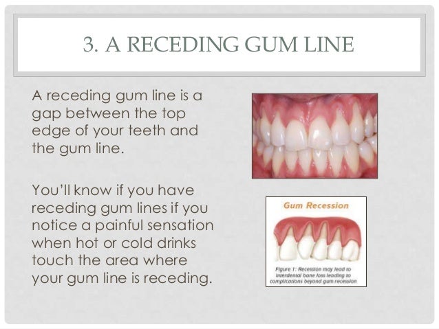 gum receding gingivitis