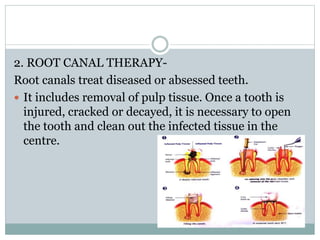 2. ROOT CANAL THERAPY-
Root canals treat diseased or absessed teeth.
 It includes removal of pulp tissue. Once a tooth is
injured, cracked or decayed, it is necessary to open
the tooth and clean out the infected tissue in the
centre.
 