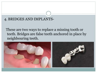 4. BRIDGES AND IMPLANTS-
These are two ways to replace a missing tooth or
teeth. Bridges are false teeth anchored in place by
neighbouring teeth.
 