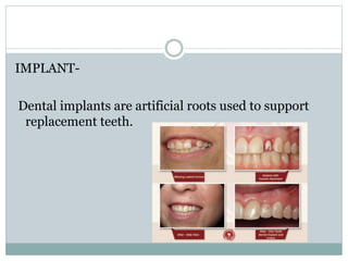 IMPLANT-
Dental implants are artificial roots used to support
replacement teeth.
 