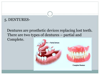 5. DENTURES-
Dentures are prosthetic devices replacing lost teeth.
There are two types of dentures – partial and
Complete.
 