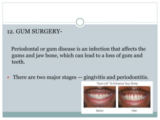 12. GUM SURGERY-
Periodontal or gum disease is an infection that affects the
gums and jaw bone, which can lead to a loss of gum and
teeth.
 There are two major stages — gingivitis and periodontitis.
 