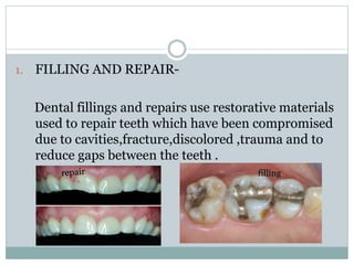 1. FILLING AND REPAIR-
Dental fillings and repairs use restorative materials
used to repair teeth which have been compromised
due to cavities,fracture,discolored ,trauma and to
reduce gaps between the teeth .
filling
 