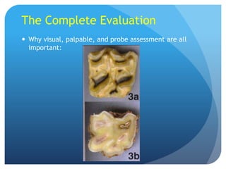 The Complete Evaluation
 Why visual, palpable, and probe assessment are all
important:
 