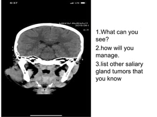 1.What can you
see?
2.how will you
manage.
3.list other saliary
gland tumors that
you know
 