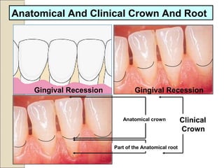 Anatomical And Clinical Crown And Root
Gingival Recession Gingival Recession
Anatomical crown
Part of the Anatomical root
Clinical
Crown
 