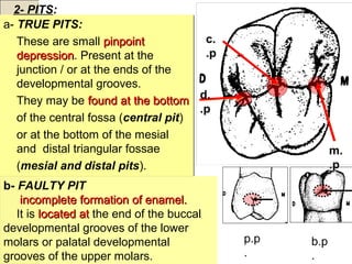 a- TRUE PITS:
These are small pinpointpinpoint
depressiondepression. Present at the
junction / or at the ends of the
developmental grooves.
They may be foundfound at the bottomat the bottom
of the central fossa (central pit)
or at the bottom of the mesial
and distal triangular fossae
(mesial and distal pits).
a- TRUE PITS:
These are small pinpointpinpoint
depressiondepression. Present at the
junction / or at the ends of the
developmental grooves.
They may be foundfound at the bottomat the bottom
of the central fossa (central pit)
or at the bottom of the mesial
and distal triangular fossae
(mesial and distal pits).
2- PITS:
b- FAULTY PIT
incomplete formation of enamel.incomplete formation of enamel.
It is located atlocated at the end of the buccal
developmental grooves of the lower
molars or palatal developmental
grooves of the upper molars.
c.
p.
d.
p.
m.
p.
p.p
.
b.p
.
 