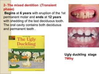 Ugly duckling stage
Why?
2- The mixed dentition :(Transient
phase)
Begins at 6 years with eruption of the 1st
permanent molar and ends at 12 years
with shedding of the last deciduous tooth.
The oral cavity contains both deciduous
and permanent teeth .
 