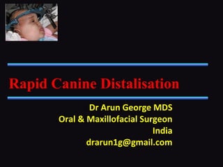 Dr Arun George MDS
Oral & Maxillofacial Surgeon
India
drarun1g@gmail.com
Rapid Canine Distalisation
 