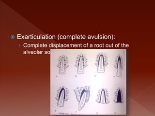dento alveolar injuries.pptx