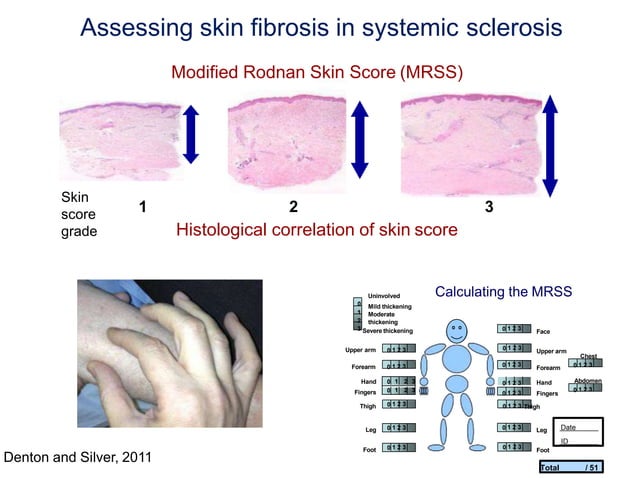 The State of Scleroderma Clinical Trials | PPTX