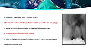→ Biodentine : five drops of liquid - triturator for 30 s.
→The material was then delicately pushed towards the apex with a root-canal plugger.
→ Several increments were required to form a plug of adequate thickness
→ After verifying that the material was hard-set
→ Gutta-percha obturation was performed using obtura II and the access cavity was
sealed using composite resin.
 