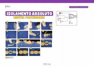 hud
Odonto
Dentística
Módulo
ISOLAMENTO
ISOLAMENTOABSOLUTO
ABSOLUTO
1
1 2
2 3
3 4
4
5
5 6
6 7
7 8
8
9
9
12
12 13
13 14
14
Isolamento absoluto - Dentes posteriores
DENTES POSTERIORES
DENTES POSTERIORES
Dentes
com
grampo
Incisivos
superiores
Incisivos
inferiores
Molares
Caninos
e Pré-
molares
11
11
10
10
11
Baratieriet al. (2010)
 