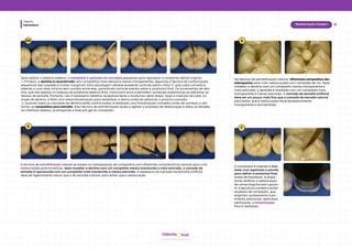 Dentística
Módulo
13
Restauração Classe I
hud
Odonto
04
5
A técnica de estratificação natural se baseia na sobreposição de compósitos com diferentes características ópticas para criar
restaurações policromáticas. Após modelar a dentina com um compósito menos translúcido e mais saturado, a camada de
esmalte é reproduzida com um compósito mais translúcido e menos saturado. A espessura da camada de esmalte artificial
deve ser ligeiramente menor que a do esmalte natural, para evitar que a restauração
Após aplicar o sistema adesivo, o compósito é aplicado em camadas pequenas para reproduzir a anatomia dental original.
1. Primeiro, a dentina é reconstruída com compósitos mais densos e menos transparentes, seguindo a técnica de conformação
sequencial das cúspides e cristas marginais. Esta abordagem oferece excelente controle sobre o fator C, pois cada camada é
aderida a uma área mínima sem contato entre elas, garantindo controle preciso sobre a anatomia final. Os incrementos de den-
tina, que são apenas um esboço da anatomia externa final, minimizam erros e permitem correções anatômicas ao adicionar as
resinas de esmalte. Portanto, não é necessário detalhar excessivamente a anatomia nesta etapa. Após a inserção de cada ca-
mada de dentina, é feita uma breve fotoativação para estabilizar a resina antes de adicionar a próxima camada.
2. Quando todas as camadas de dentina estão conformadas, é realizada uma fotoativação completa antes de começar a adi-
cionar os compósitos para esmalte. Esta técnica de polimerização ajuda a agilizar o processo de restauração e reduz as tensões
na interface adesiva, prolongando a fase pré-gel do compósito.
6
Na técnica de estratificação natural, diferentes compósitos são
sobrepostos para criar restaurações com variações de cor. Após
modelar a dentina com um compósito menos transparente e
mais saturado, o esmalte é moldado com um compósito mais
transparente e menos saturado. A camada de esmalte artificial
deve ser um pouco mais fina que a camada de esmalte natural
para evitar que a restauração fique excessivamente
transparente e acinzentada.
7
O compósito é inserido e mol-
dado com espátulas e pincéis
para definir a anatomia final.
Antes de fotoativar, é impor-
tante verificar a restauração
de vários ângulos para garan-
tir a escultura correta e evitar
excessos de compósito, que
exigiriam acabamento e po-
limento adicionais. Após essa
verificação, a fotoativação
final é realizada.
 
