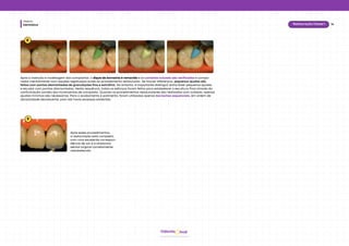 Dentística
Módulo
14
Restauração Classe I
hud
Odonto
8
9
Após esses procedimentos,
a restauração está completa,
com uma excelente correspon-
dência de cor e a anatomia
dental original corretamente
restabelecida.
Após a inserção e modelagem dos compósitos, o dique de borracha é removido e os contatos oclusais são verificados e compa-
rados mentalmente com aqueles registrados antes do procedimento restaurador. Se houver diferenças, pequenos ajustes são
feitos com pontas diamantadas de granulações fina e extrafina. No entanto, é importante distinguir entre fazer pequenos ajustes
e esculpir com pontas diamantadas. Nesta sequência, todos os esforços foram feitos para estabelecer a escultura final através da
conformação correta dos incrementos de compósito. Quando os procedimentos restauradores são realizados com cuidado, apenas
ajustes mínimos são necessários. Para o acabamento e polimento, foram utilizadas apenas borrachas sequenciais, em ordem de
abrasividade decrescente, pois não havia excessos evidentes.
 