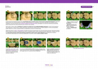 Dentística
Módulo
17
Restauração Classe II
hud
Odonto
07
8 9
Finalmente﻿
, após inserir o con-
junto matriz/cunha/anel, é cru-
cial verificar a adaptação em
todas as margens para evitar
excessos marginais.
A face proximal dos dentes naturais tem convexidades tanto no sentido cérvico-oclusal quanto vestibulolingual/palatal. Reproduzir
essas formas com matrizes planas é muito difícil, especialmente com compósitos, que não são aplicados com pressão como o
amálgama. Uma boa solução é usar matrizes metálicas parciais biconvexas, que seguem os contornos anatômicos dos dentes.
Essas matrizes vêm em vários tamanhos para molares e pré-molares.
Após inserir a matriz, deve-se estabilizá-la e ajustá-la ao dente com uma cunha de madeira adequada. Cunhas muito pequenas
não pressionam a matriz contra o dente, permitindo vazamento de material além da margem gengival. Cunhas muito grandes
podem deformar a matriz, causando falhas na adaptação e contorno da restauração.
Depois de colocar a cunha, o anel metálico do sistema de matriz é posicionado com uma pinça porta-grampos, exercendo pressão
entre os dente. Isso melhora a adaptação da matriz à cavidade e ajuda a obter contatos proximais adequados. Também é útil usar
um instrumento de ponta romba para pressionar levemente a matriz contra o dente adjacente, garantindo bom contato e
minimizando restaurações com contornos inadequados. No entanto, deve-se evitar amassar a matriz.
Uso de gel de ácido fosfórico a 37% em toda a margem de es-
malte. Na face oclusal, o ácido deve se estender 1 a 2 mm além
da margem para um condicionamento adequado.
Lavar a cavidade com jatos de
água. Remover o excesso de
umidade da dentina com uma
bolinha de algodão. Secar o es-
malte com jatos de ar.
10
• Aplicar múltiplas camadas
de adesivo com um pincel
descartável.
• Remover excessos de a-
desivo, especialmente na
margem gengival.
• Realizar a fotoativação
do adesivo.
11
Início pela caixa proximal.
 