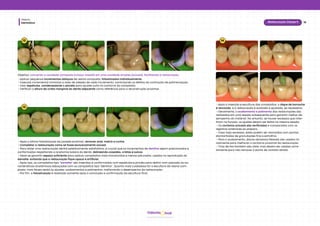 Dentística
Módulo
18
Restauração Classe II
hud
Odonto
12
13
Objetivo: converter a cavidade composta (ocluso-mesial) em uma cavidade simples (oclusal), facilitando a restauração.
• Aplicar pequenos incrementos oblíquos de resina composta, fotoativados individualmente.
• Inserção incremental minimiza a área de adesão de cada incremento, controlando os efeitos da contração de polimerização.
• Usar espátulas, condensadores e pincéis para ajustes sutis no contorno do compósito.
• Verificar a altura da crista marginal do dente adjacente como referência para a reconstrução proximal.
• Após a última fotoativação da parede proximal, remover anel, matriz e cunha.
• Completar a restauração como se fosse exclusivamente oclusal.
• Para obter uma restauração dental esteticamente satisfatória, é crucial que os incrementos de dentina sejam posicionados e
conformados respeitando a anatomia básica do dente, delineando cúspides, cristas e sulcos.
• Deve-se garantir espaço suficiente para aplicar compósitos mais translúcidos e menos saturados, usados na reprodução do
esmalte, evitando que a restauração fique opaca e artificial.
• Após isso, os compósitos tipo "esmalte" são inseridos e conformados com espátulas e pincéis para definir com precisão as ca-
racterísticas anatômicas esboçadas com os compósitos tipo "dentina". Quanto mais cuidadosa for a escultura da resina com-
posta, mais fáceis serão os ajustes, acabamentos e polimentos, melhorando o desempenho da restauração.
• Por fim, a fotoativação é realizada somente após a conclusão e confirmação da escultura final.
14
• Após a inserção e escultura dos compósitos, o dique de borracha
é removido, e a restauração é avaliada e ajustada, se necessário.
• Geralmente, o acabamento e polimento das restaurações são
realizados em uma sessão subsequente para garantir melhor de-
sempenho do material. No entanto, se houver excessos que inter-
firam na função, os ajustes devem ser feitos na mesma sessão.
• Os contatos oclusais são verificados e comparados com os
registros anteriores ao preparo.
• Caso haja excessos, estes podem ser removidos com pontas
diamantadas de granulações fina e extrafina.
• Para o acabamento, discos abrasivos flexíveis são usados ini-
cialmente para melhorar o contorno proximal da restauração.
• Tiras de lixa também são úteis, mas devem ser usadas corre-
tamente para não remover o ponto de contato obtido.
 