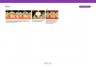 Dentística
Módulo
19
Restauração Classe II
hud
Odonto
15
Na face oclusal, um polimento excelente é alcançado utili-
zando borrachas abrasivas sequenciais, aplicadas em ordem
decrescente de abrasividade.
16 17
Outra opção é o uso de esco-
vas abrasivas especiais.
A restauração final deve apre-
sentar excelente integração
óptica e anatômica ao re-
manescente dental.
 