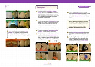 Dentística
Módulo
22
Restauração Classe III
hud
Odonto
08 09
10 11
Após a conclusão da restauração, a cunha é
removida, e o isolamento absoluto é retirado.
Os dentes voltam à posição original, restauran-
do os contatos proximais, a estética e a função.
12
12 12
PreparoerestauraçãoclasseIIIcomcompósitos
Acesso palatal
O processo começa marcando os contatos
oclusais e fazendo uma profilaxia → verificar os
contatos oclusais é crucial para definir os limi-
tes da cavidade, e a presença deles na interface
não é recomendada, pois pode prejudicar a
durabilidade da restauração.
01
Mesmo que a lesão cariosa não afete direta-
mente a face vestibular, a seleção de cores deve
ser feita com cuidado → com pequenas aplica-
ções de compósito e fotoativação adequada.
A lesão é ligeiramente visível em vista lateral, e os
tecidos dentários são translúcidos, de modo que
os materiais restauradores na face palatal afetam
o aspecto visual da face vestibular.
02
O próximo passo é isolar eficazmente o campo
operatório, usando um lençol de borracha.
03
Para﻿melhor acesso à lesão, é feita uma leve se-
paração dental com uma cunha de madeira. Às
vezes, a altura da cunha pode dificultar a visuali-
zação e o acesso ao tecido cariado, sendo neces-
sário fazer pequenos desgastes para liberar o
acesso à cavidade.
04
01 02
03 04
A escolha de brocas com o tamanho adequado
é crucial para equilibrar efetividade e segurança
durante o preparo de cavidades → o ideal é que
o diâmetro da broca seja compatível com o
tamanho da lesão cariosa, sendo a maior
possível em relação ao tamanho da lesão.
06 07
Após a remoção do tecido cariado, a cavidade
é limpa, e os procedimentos adesivos são inici-
ados.
06
Uma tira de poliéster é inserida entre o dente
a ser restaurado e a cunha de madeira para
proteger o dente adjacente durante o condi-
cionamento ácido com gel de ácido fosfórico.
07
05 05
A cunha adaptada anteriormente prende
agora uma matriz metálica, protegendo o dente
adjacente durante a remoção do tecido cariado,
realizada com brocas esféricas lisas em baixa
rotação.
05
Baratieriet al. (2010)
 