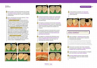 Dentística
Módulo
23
Restauração Classe III
hud
Odonto
Após a hibridização dos tecidos dentais, a inser-
ção dos compósitos é iniciada.
1. A primeira massa de resina composta aplicada é
referente ao esmalte proximal e é posicionada contra
a parede vestibular do preparo e a matriz de poliéster.
Em seguida, a matriz é tracionada em direção vesti-
bular para adaptar o compósito às margens do pre-
paro. Uma vez que o esmalte proximal está correta-
mente reproduzido e contornado, ele é fotoativado.
2. Um segundo incremento de resina composta, refe-
rente à dentina, é inserido, reproduzindo-a até as
proximidades do contorno final desejado para a
restauração na face palatal. É importante deixar um
espaço para uma última camada de compósito, com
características ópticas de esmalte. Após a inserção
dos compósitos de dentina, é realizada a fotoativação.
Após lavagem e remoção de excesso de umidade,
um sistema adesivo é aplicado → os solventes são
volatilizados com jatos de ar suaves, e a superfície
é fotoativada.
08
09
3. A última camada de compósito, correspondente
ao esmalte palatal, é inserida e moldada com espá-
tulas e, de preferência, pincéis, para obter superfíc-
ies lisas. Após a conformação adequada do "esmalte
artificial" palatal, a fotoativação é realizada.
08 09
09 09
09 09
A fase de acabamento começa com a separação
da restauração do dente adjacente, feita inserin-
do uma espátula na ameia incisal e aplicando
uma leve torção.
10
Em seguida, os excessos proximais são removidos
com uma lâmina de bisturi número 12, trabalhando
da estrutura dental em direção à restauração para
evitar a remoção acidental de compósito nas
margens.
11
O isolamento absoluto é removido para concluir
os procedimentos de acabamento e polimento,
os quais são realizados com lixas abrasivas de
granulação decrescente.
12
Em seguida, os contatos são verificados e ajus-
tados com pontas diamantadas extrafinas ou
brocas multilaminadas, para que fiquem se-
melhantes aos contatos originais.
13
12 13
10 11
PreparoerestauraçãoclasseIIIcomcompósitos
Acesso vestibular
01
02
03
04
A face palatal é acabada com borrachas
abrasivas e polida com escovas Robinson e
pastas especiais.
14
14 14
Após a profilaxia, a seleção de cores é cuida-
dosamente feita, usando escalas e pequenos
incrementos de compósito.
O sucesso estético depende do equilíbrio entre massas
de resina composta para dentina (menos translúcidas)
e massas para esmalte (mais translúcidas), evitando o
uso excessivo de compósitos translúcidos ou de dentina
para alcançar uma restauração esteticamente agradável.
Para tornar o processo mais visível, acessível e
confortável para o paciente, o campo operatório
é isolado com um lençol de borracha.
O dente adjacente à área de trabalho é protegido
com uma cunha e uma matriz metálica.
As brocas esféricas lisas em b﻿
aixa rotação
são usadas para áreas com tecido cariado
ou manchadas.
 