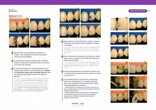 Dentística
Módulo
24
Restauração Classe III
hud
Odonto
03 04
01 02
Depois disso, os procedimentos adesivos co-
meçam, com proteção dos dentes adjacentes
usando tiras de poliéster.
05
A superfície do dente é condicionada, o sistema
adesivo é aplicado e fotoativado após a remoção
do excesso de umidade.
06
A chave para obter bons resultados estéticos em
restaurações Classe III na face vestibular é replicar
a translucidez observada nos dentes naturais, além
das relações de espessura entre o esmalte e a
dentina.
Em casos em que a face palatal não está envolvida no
preparo, o primeiro incremento de compósito é usado
para reproduzir a relação de contato proximal entre a
restauração e o dente adjacente. Duas técnicas são
sugeridas para aplicar esse incremento: uma envolve
uma matriz de poliéster estabilizada por uma cunha
de madeira, e a outra envolve uma matriz de poliéster
tracionada para palatal antes da fotoativação.
07
Após restaurar a face proximal, o próximo passo é
reproduzir a porção de dentina perdida no prepa-
ro cavitário.
Isso é feito usando uma resina menos translúcida e mais
saturada, mantendo o equilíbrio entre translucidez e vo-
lume de dentina e esmalte para alcançar uma estética
adequada.
08
Após a inserção do compósito para dentina, ainda
deve haver um espaço a ser preenchido pelo com-
pósito para esmalte.
A última camada de compósito, responsável por replicar
as características ópticas do esmalte, é aplicada e con-
formada com espátulas e pincéis para minimizar os ex-
cessos.
09
A etapa de acabamento e polimento começa com
a remoção de excessos proximais usando um bisturi
com lâmina 12.
10
Os procedimentos de acabamento e polimento
devem ser realizados em uma sessão separada
para uma avaliação estética adequada e melho-
res propriedades dos materiais.
• Nesse exemplo, o acabamento começou na face pro-
ximal da restauração, usando tiras de lixa em ordem de
aspereza decrescente.
• Depois, discos abrasivos flexíveis foram usados para
fazer pequenos ajustes na forma e áreas reflexivas,
seguidos pela aplicação de pastas de polimento
usando discos de feltro.
11
06 07
05 06
09 09
10
08 08
11 11
11 11
11 11
Baratieriet al. (2010)
 