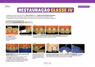 Dentística
Módulo
26
Restauração Classe IV
hud
Odonto
RESTAURAÇÃO
RESTAURAÇÃO CLASSE IV
CLASSE IV
• As lesões de Classe IV envolvem tanto a face proximal quanto o ângulo incisal dos dentes anteriores.
• São frequentemente causadas por cárie e traumas bucais, principalmente em pacientes jovens.
• A restauração é sempre um desafio devido à importância da cor e da forma dos dentes na aparência.
Técnica da guia de silicone
1 2 3
Em primeiro lugar, é impor-
tante avaliar e marcar
os contatos oclusais para
garantir que a restauração
não afete a função da
mordida.
É realizado, então, a profilaxia. Após a profilaxia, diferentes massas de resina composta são aplicadas e fotoativadas no
dente para escolher as que melhor reproduzem as caracteísticas ópticas do esmalte e
da dentina, incluindo matiz, croma, valor e trans- lucidez.
4 6
5
O ensaio restaurador deve ser realizado rapidamente, sem
isolamento prévio, para evitar a desidratação do dente e
alteração momentânea da cor.
- Após a avaliação do ensaio, se satisfatório, registrar
uma "receita" das cores e espessuras usadas.
- Caso contrário, repetir o ensaio até encontrar a com-
binação ideal. Antes dos procedimentos restauradores,
considerar transferir a forma do ensaio para a restaura-
ção definitiva, utilizando uma guia de silicone.
A remoção do ensaio, sem pro-
cedimentos adesivos prévios,
é simples, destacando-o com
cuidado para evitar resíduos
que comprometam a restaura-
ção final.
A confecção da guia de silicone começa com a moldagem da arcada dentária, seguida pela
criação de um modelo em gesso. Sobre esse modelo, é feito um enceramento reproduzindo a
forma desejada para a restauração. Um molde de silicone é então feito sobre o modelo
encerado, sendo cuidadosamente cortado para criar uma matriz.
Baratieriet al. (2010)
 